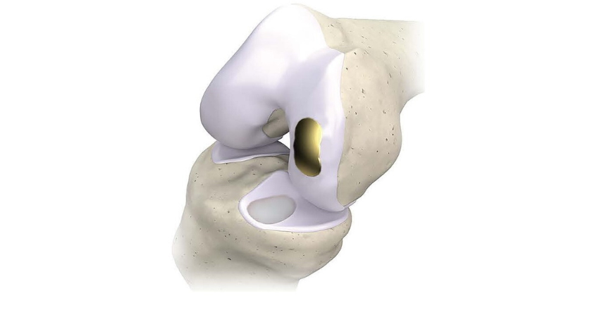 Overture Orthopaedics Marks Sales Milestone
